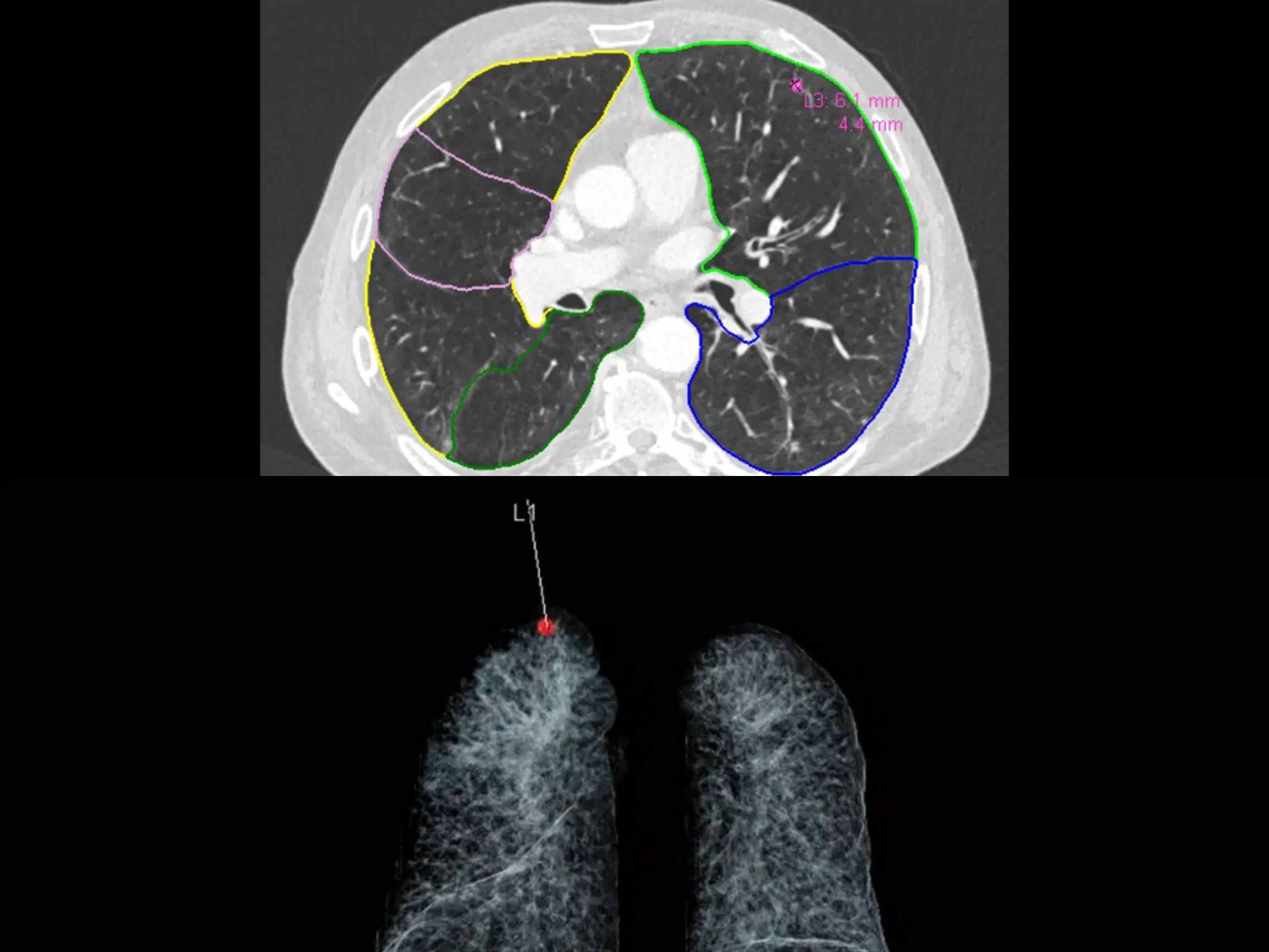 A medical image showing a thoracic CT scan with colored outlines on the lungs, indicating specific areas for examination. Below is a 3D visualization of lung tissue with a highlighted spot, possibly indicating a point of interest.