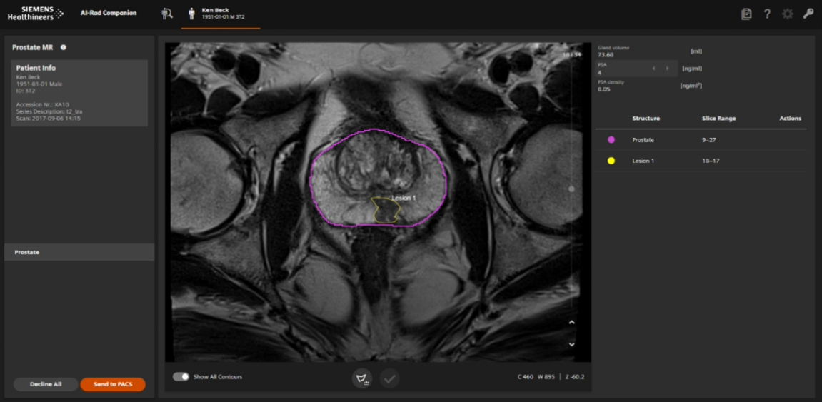 MRI scan of a prostate displayed on a medical software interface. The prostate is outlined in purple, with a specific region highlighted in yellow. Various measurement data and controls are visible around the image.