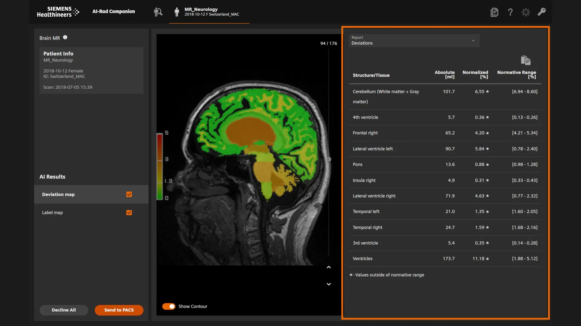 A brain MRI analysis screen shows a sagittal view with highlighted green and orange areas. The right side displays a table listing brain structures and measurements. Controls and options are seen on the left.
