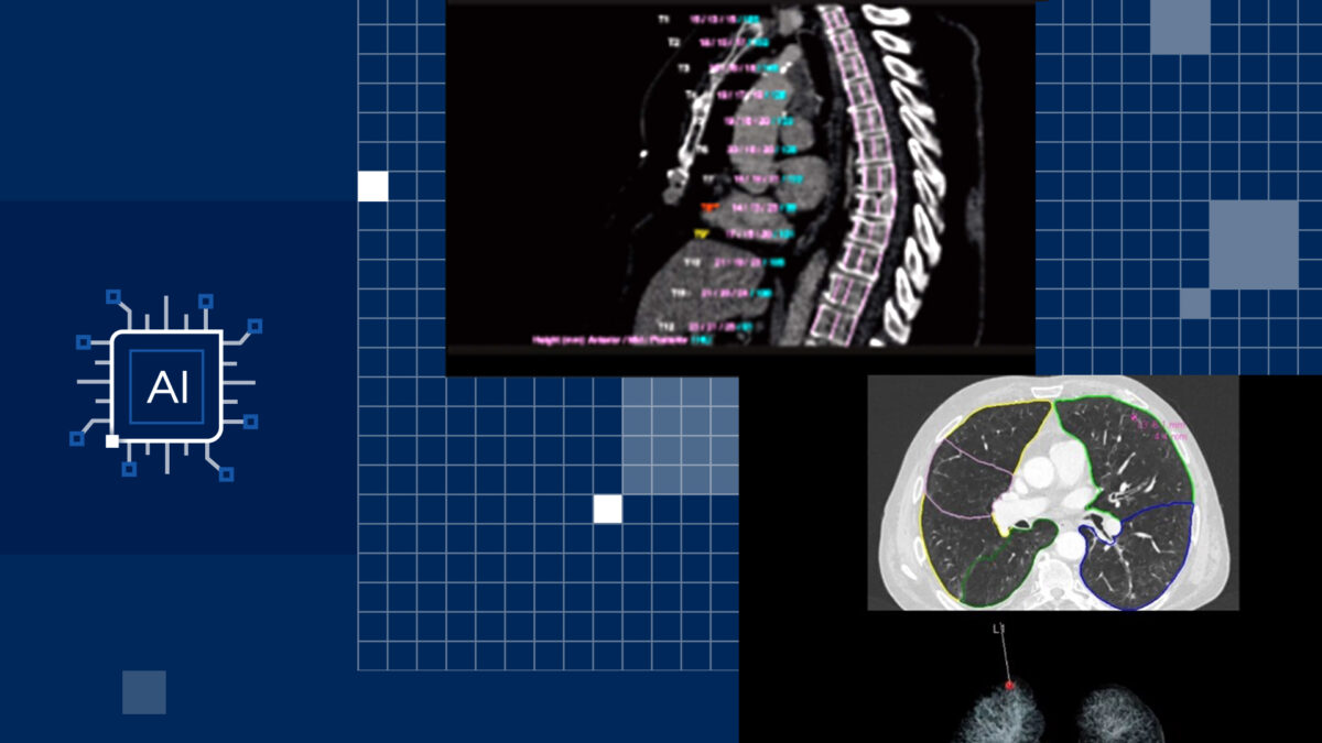 Collage of medical images on a grid background. Top image shows a spinal MRI with measurements. Bottom image is a lung CT scan with color annotations. A circuit symbol labeled AI is on the left.